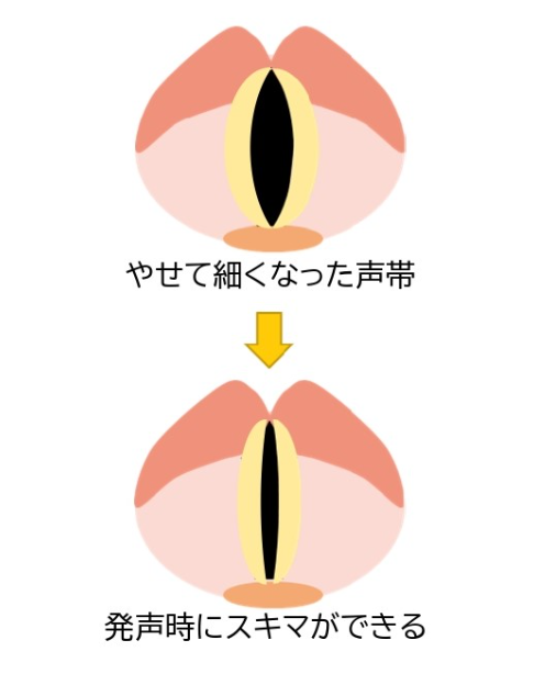 フワちゃんの喉不調の原因は声帯結節やポリープ？コロナの可能性も？休養期間は？ | 素朴なぎもん.com